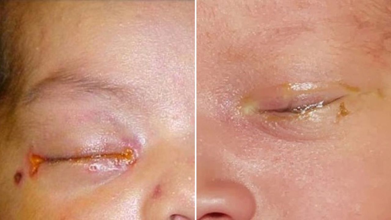 Bệnh lậu ở trẻ em