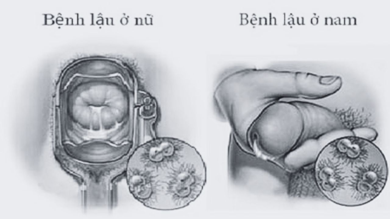 Điều trị bệnh lậu ở Vinh